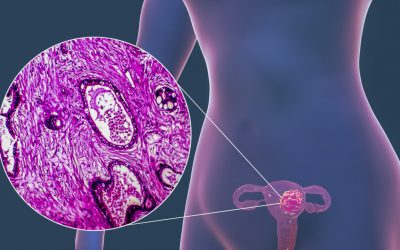 Rak endometrium